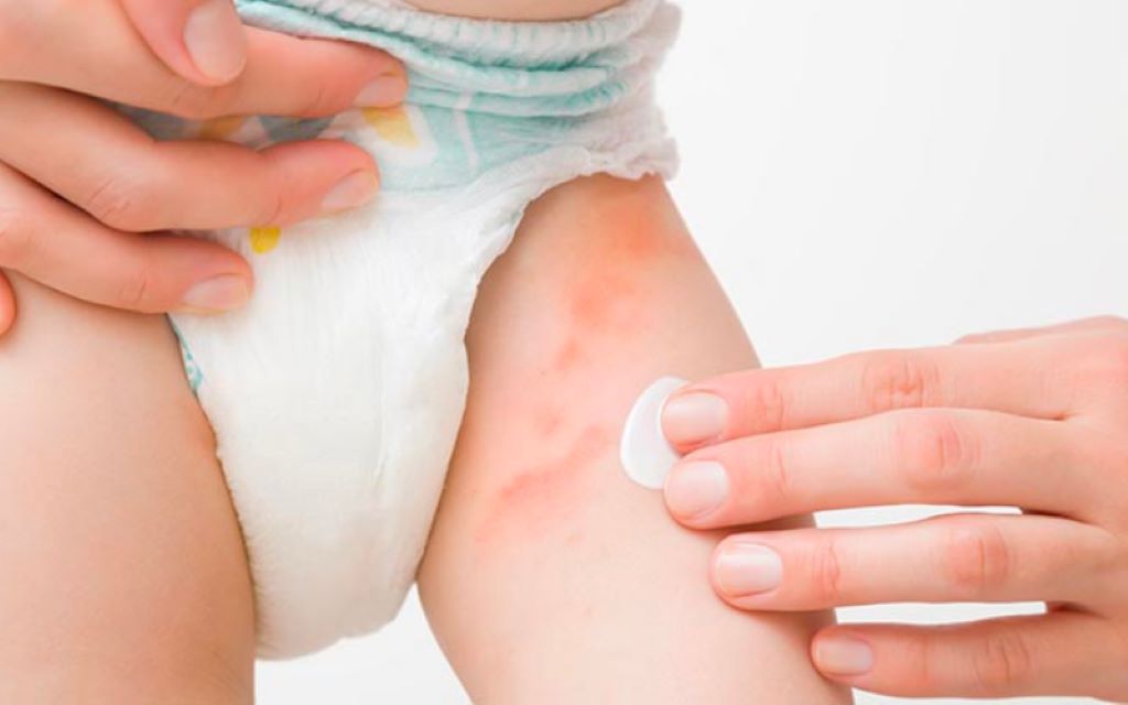 How to Get Rid of a Diaper Rash in 24 Hours: A Comprehensive Guide