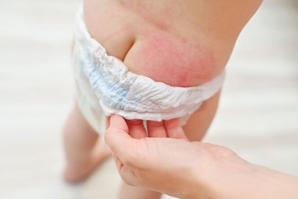 How to Heal Diaper Rash: A Comprehensive Guide