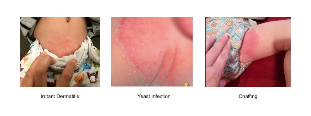 Diaper Rash vs Yeast Infection: A Comprehensive Guide to Identification and Treatment