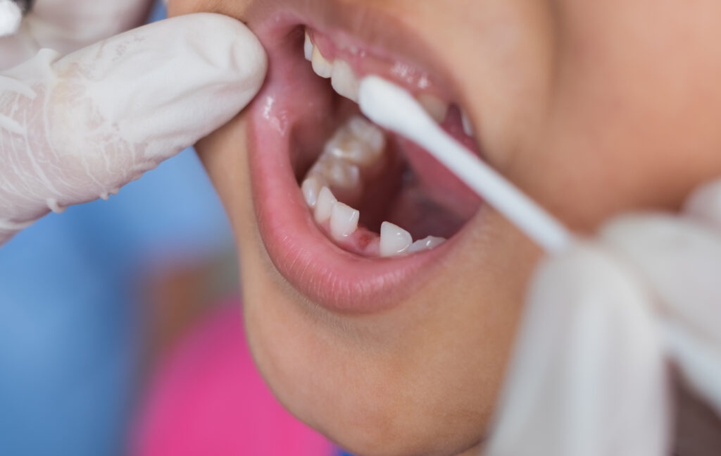 Pediatric dentist applying fluoride varnish to happy toddler's teeth during check-up